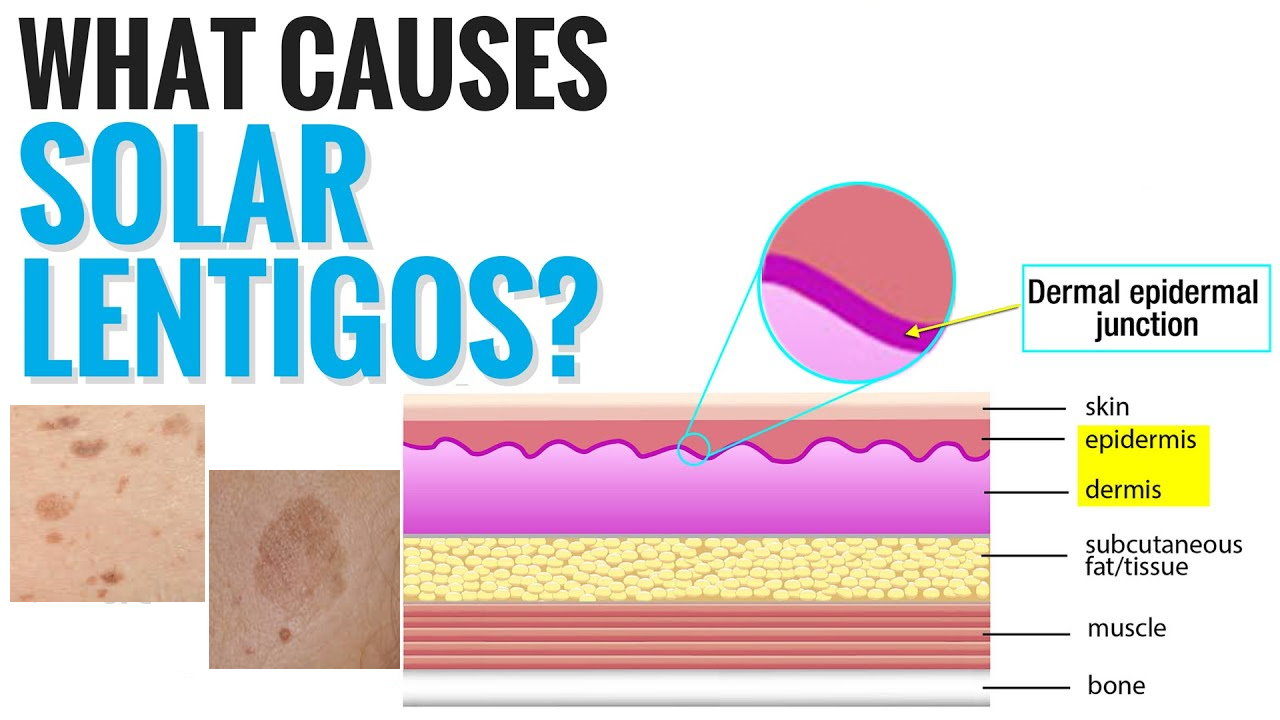 孚美达“氟轻松氢醌维A酸乳膏”能用于老年斑治疗吗？