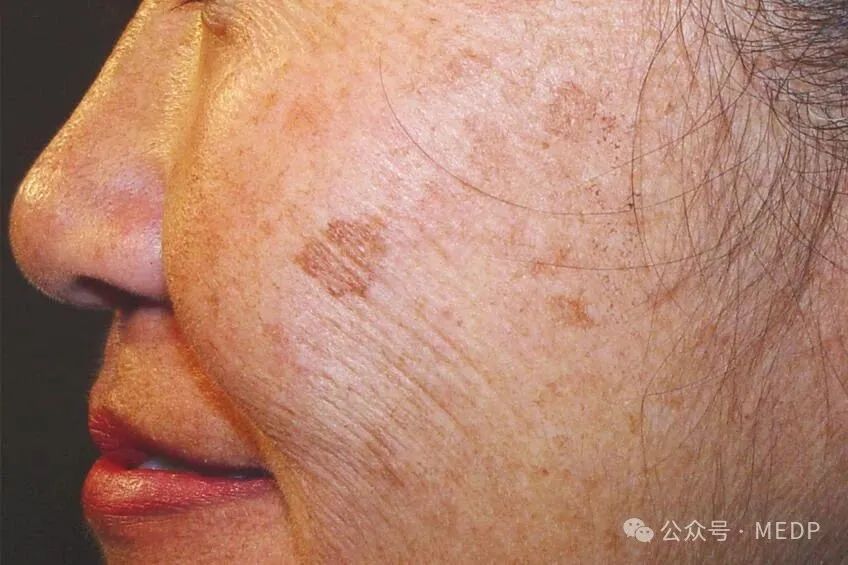 老年斑、晒斑、日光性雀斑是一回事吗？